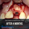 ONLINE MASTERCLASS of SOFT TISSUE MANAGEMENT In BONE GRAFTING PRE-LAUNCH DISCOUNT -70%